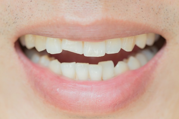 Why Is It Important To Get A Chipped Tooth Repaired?