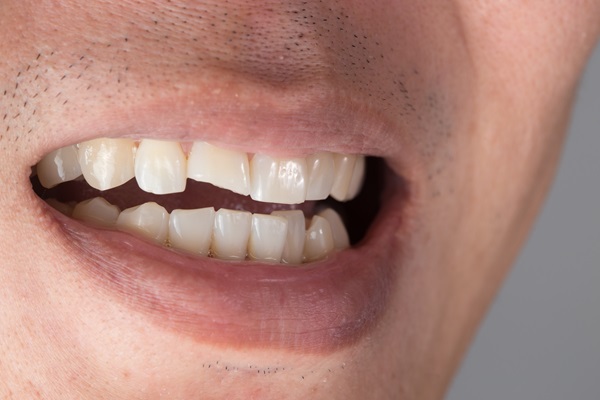 What To Do When You Have A Chipped Tooth