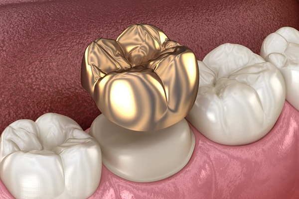 The FAQ&#    ;s Of Gold Dental Crowns