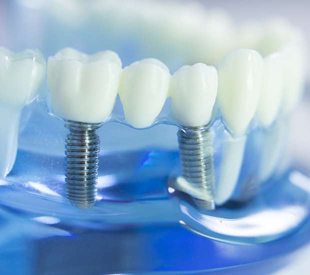 Fontana Dental Implants