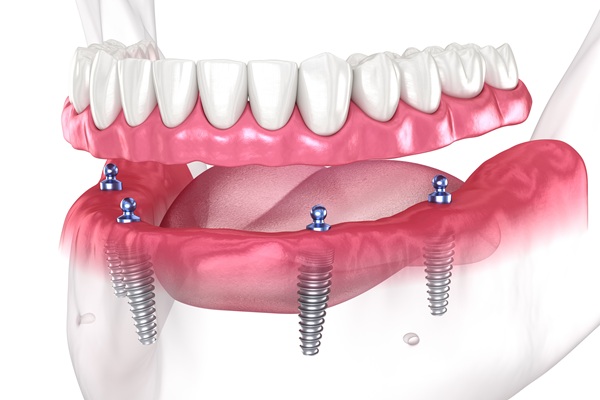 Common Questions About Implant Supported Dentures